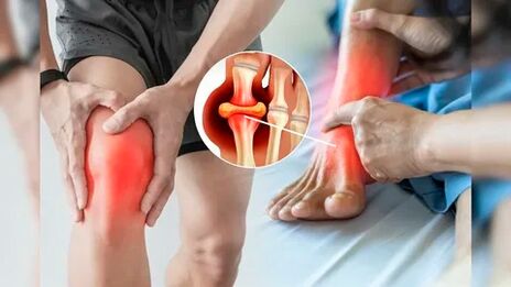 Zonas da pel adecuadas para aplicar o xel Icexin (xeonllos, cóbados, lumbar)