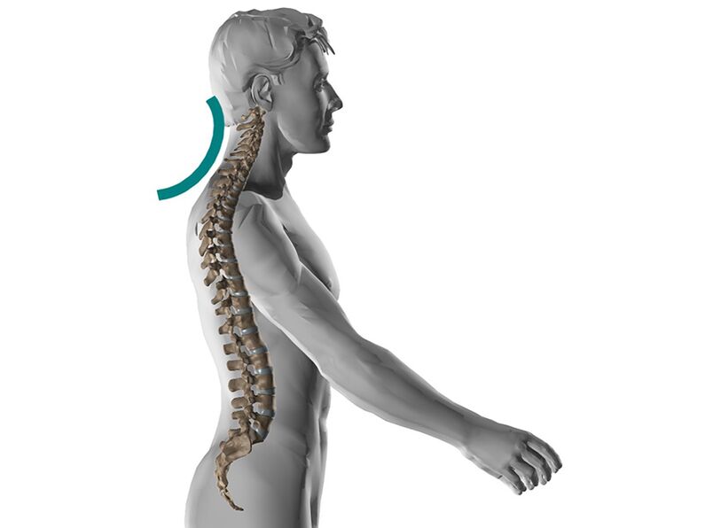 Osteocondrose cervical da columna vertebral, que causa moitos síntomas desagradables