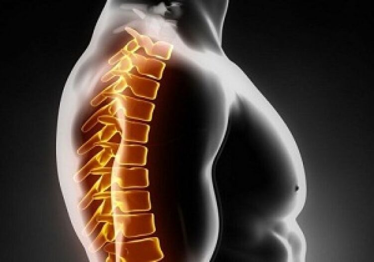 A osteocondrose torácica vai acompañada de dor e molestias no medio das costas