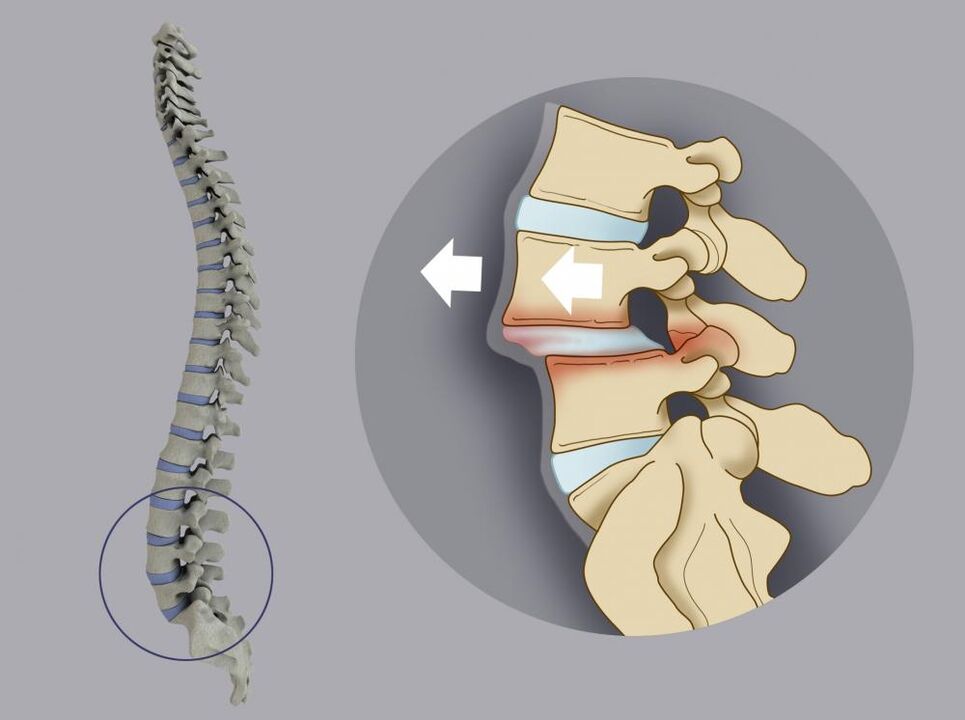 Desalineación vertebral como causa de dor nas costas
