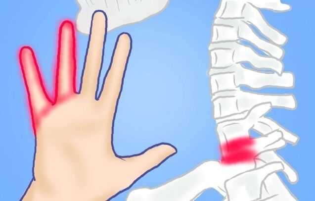 Nervios pinchados como causa da dor lumbar