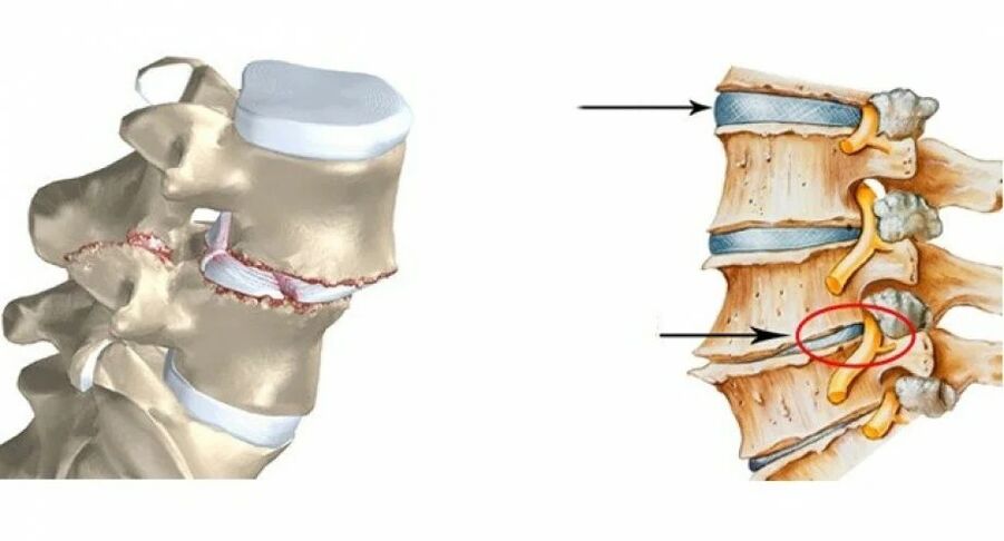 disco intervertebral normal e danado