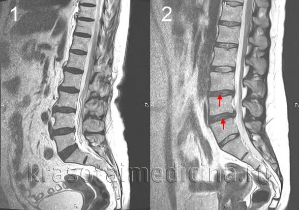 Osteocondrose da columna